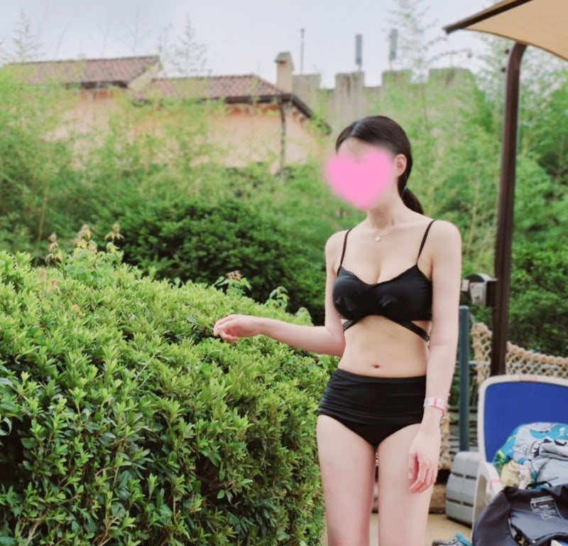 모티바 1년 4개월 차 후기_넥스트성형외과