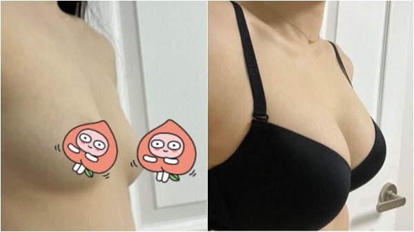 가슴성형 후기 3개월 차