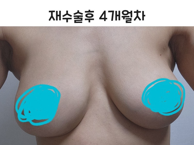 식염수 백 파열 후 재수술 후기-가슴재수술 사진 3