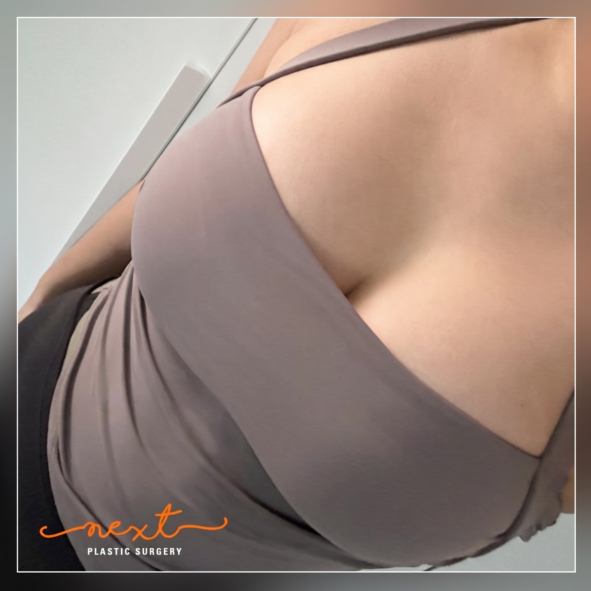 隆乳手術切口:腋下切口?乳下緣切口?? 사진 4