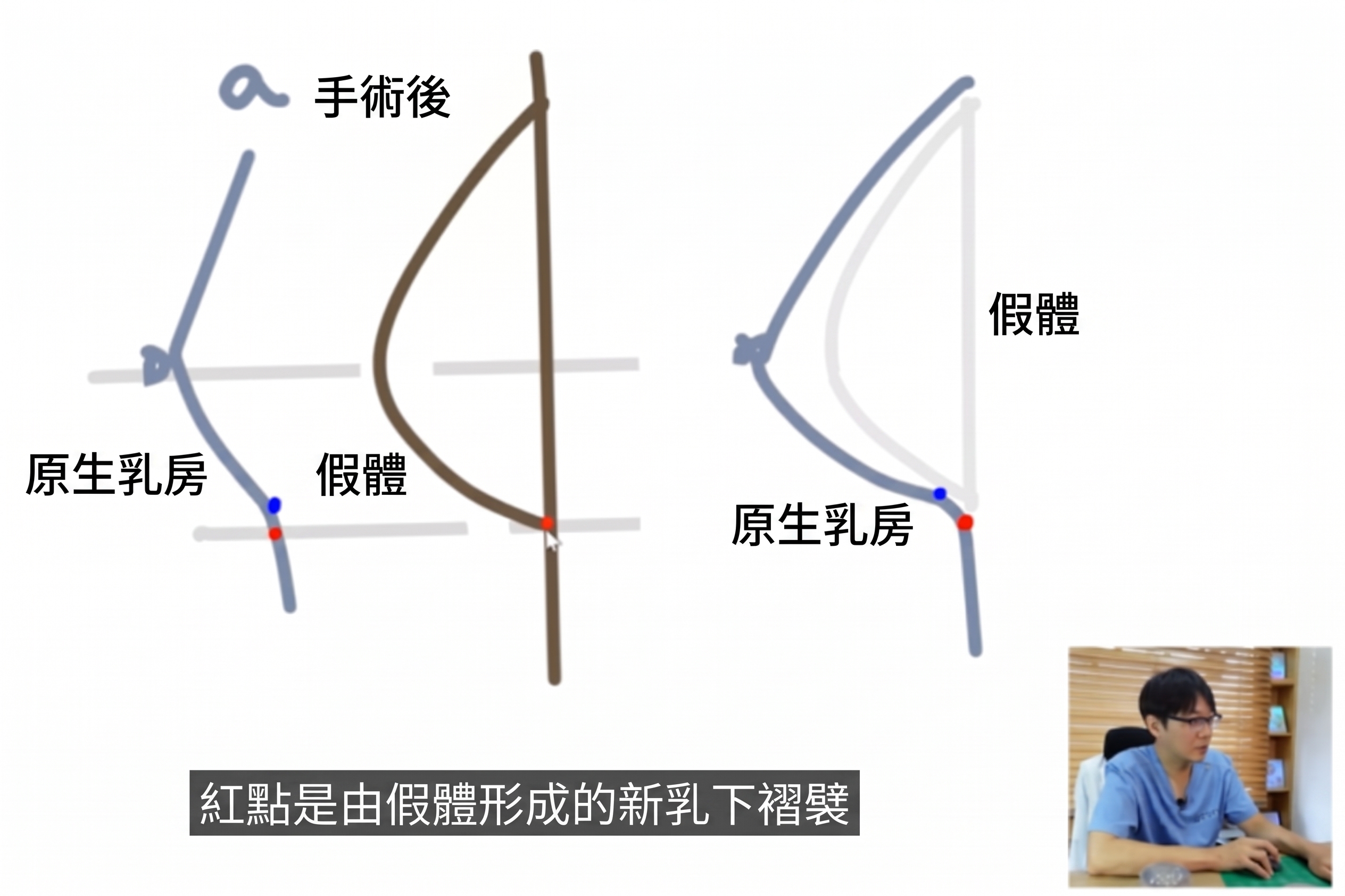 決定植入物隆乳手術時的兩大關鍵？ 사진 6