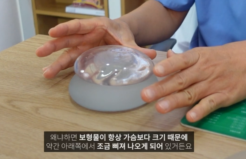 보형물 가슴확대수술 결정 시 중요한 두가지?? 사진 5