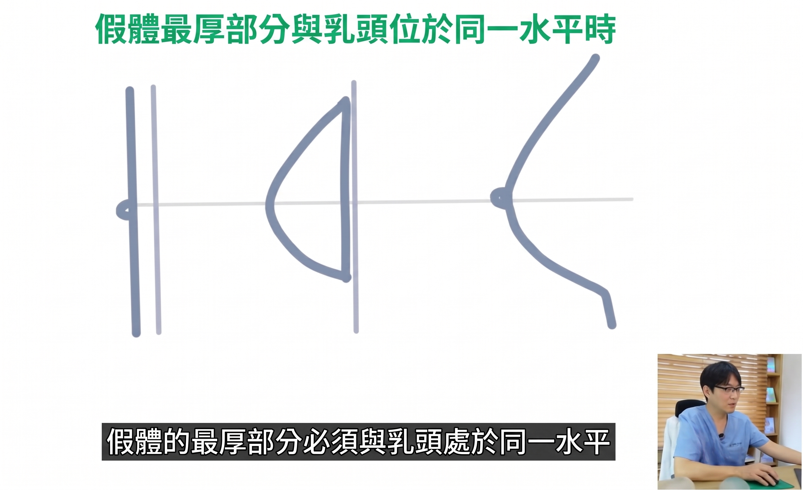 決定植入物隆乳手術時的兩大關鍵？ 사진 3